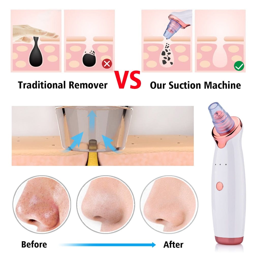 Heidi-Mode | Blackhead Instrument Elektrisch Saugwerkzeug Gesicht Wasch Instrument Schönheit Akne Reinigung Blackhead Saugwerkzeug