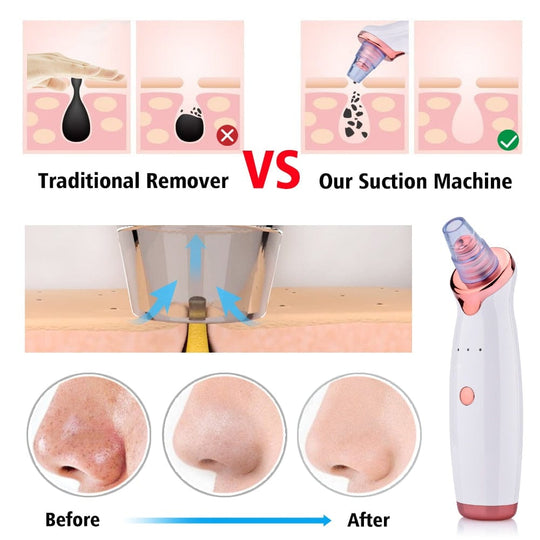 Heidi-Mode | Blackhead Instrument Elektrisch Saugwerkzeug Gesicht Wasch Instrument Schönheit Akne Reinigung Blackhead Saugwerkzeug
